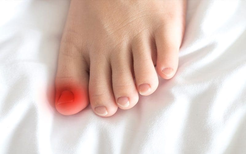 Ingrown toenails - treatment, symptoms, causes and prevention