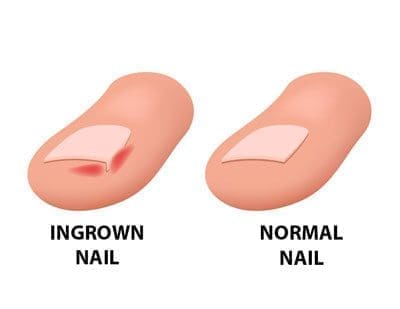 Ingrown Nails: Causes, Prevention, and Treatment