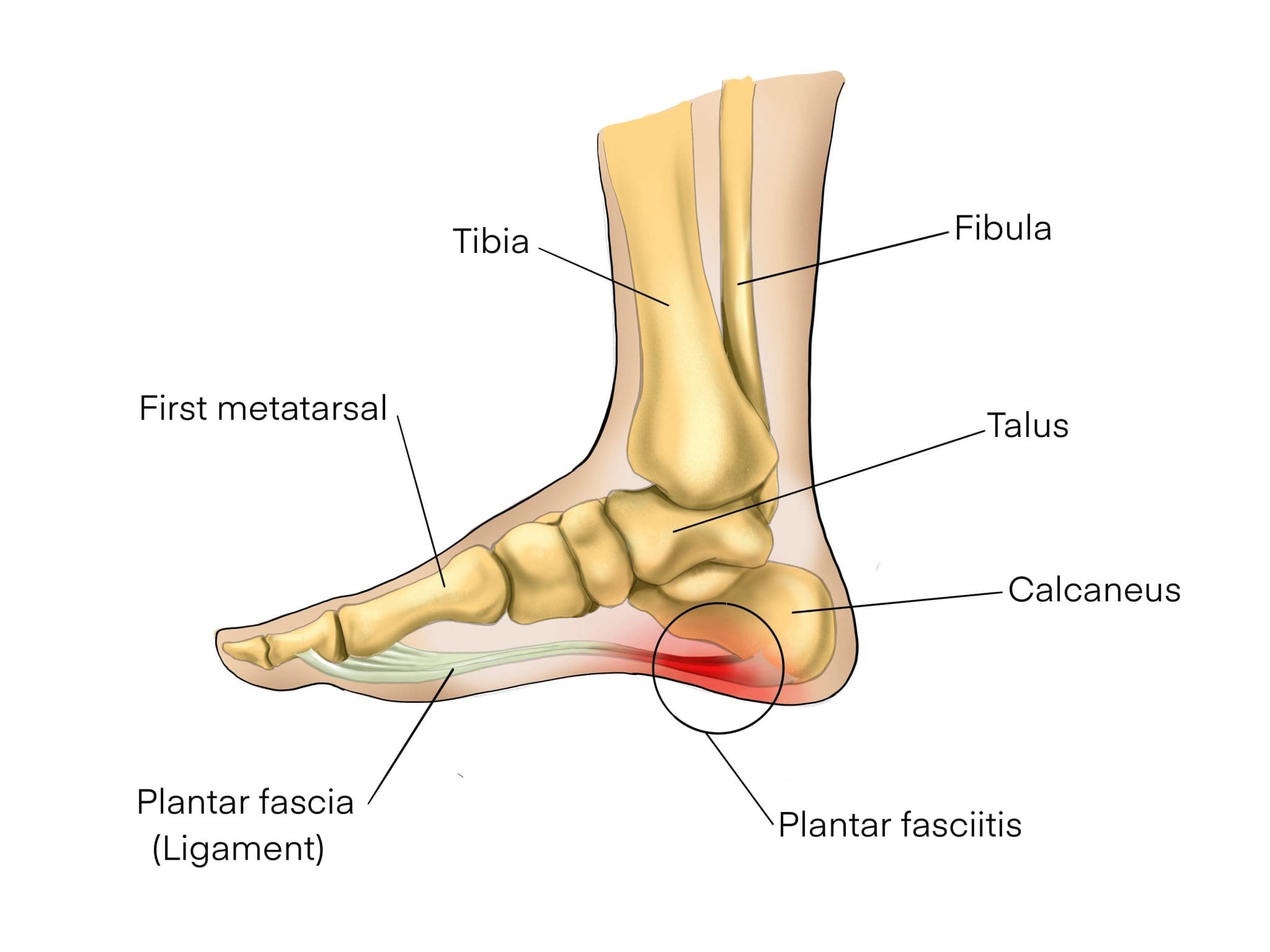 Plantar on sale fasciitis feet